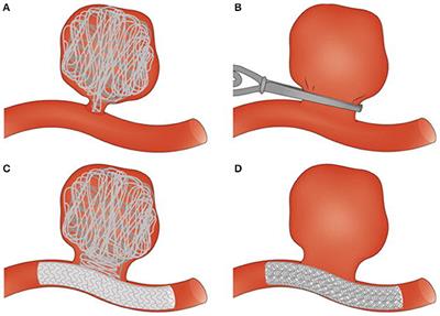 Thrombosis in Cerebral Aneurysms and the Computational Modeling Thereof: A Review